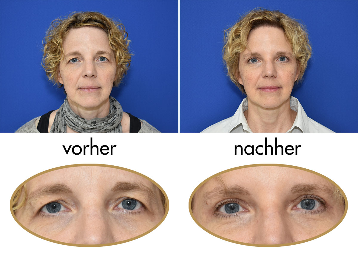 Schlupflider Vorher-Nachher im Kuzbari Zentrum Wien