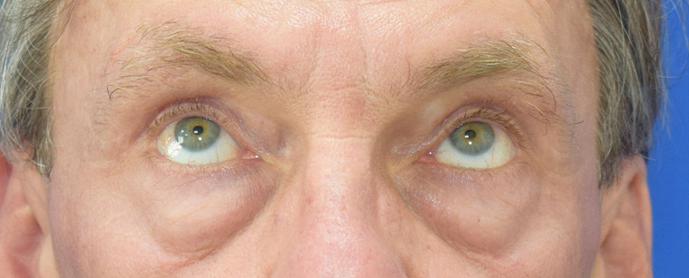 Tränensäcke vorher — Blick nach oben