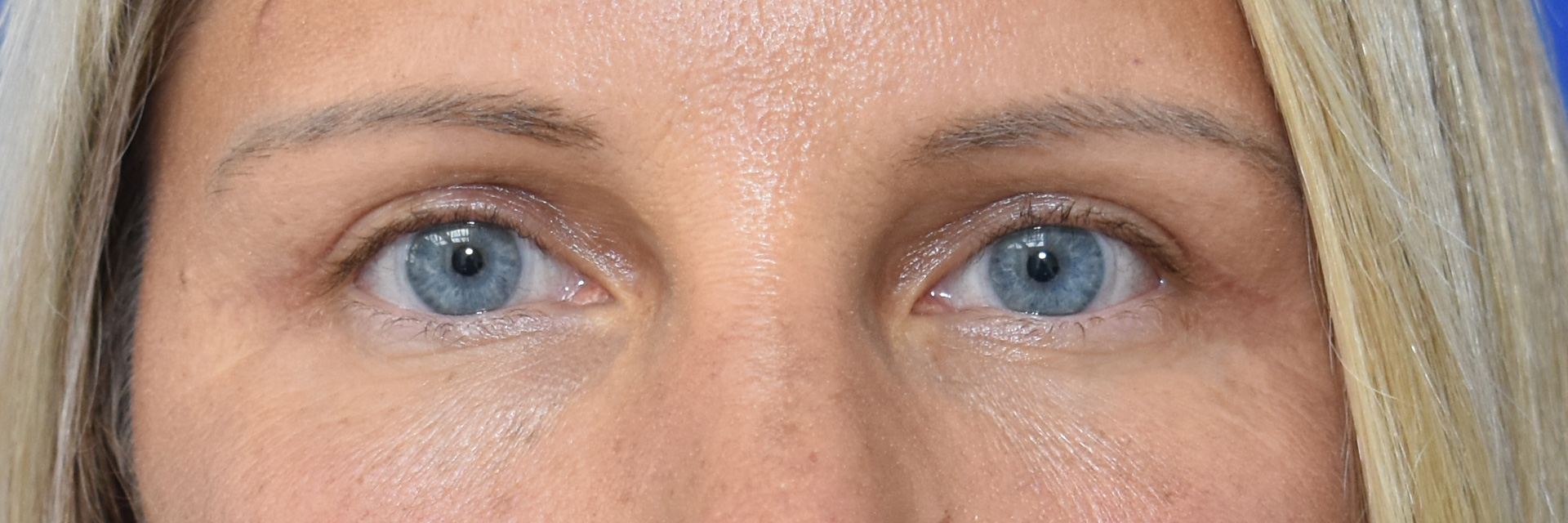 Oberlidkorrektur Nachher (1)
